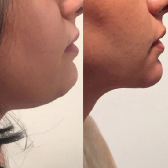 Λεμφικά Σκουλαρίκια Γερμανίου με Μαγνητοθεραπεία